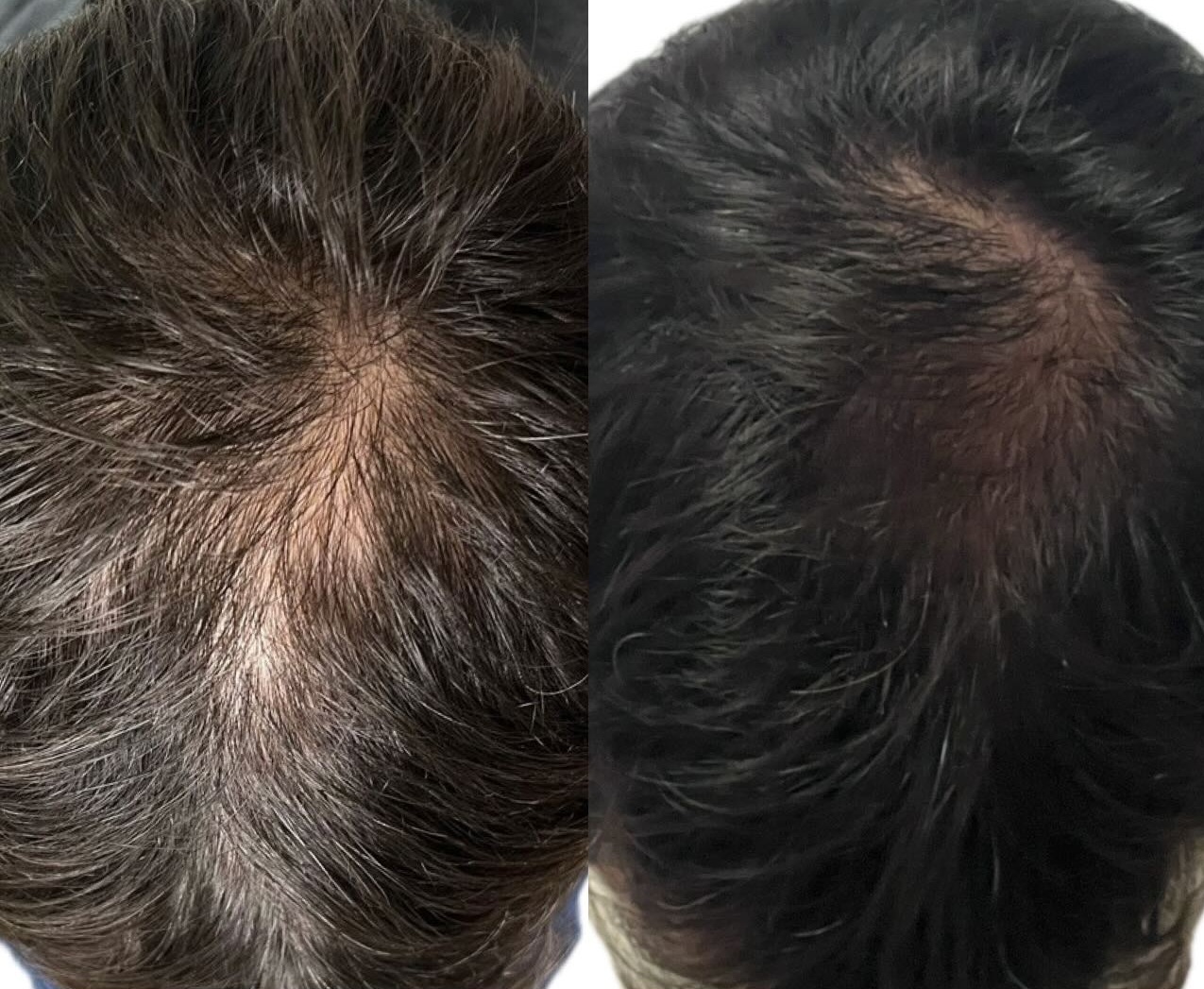 Queda de Cabelo (Tricologia)